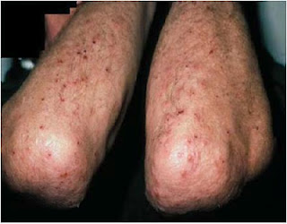 dapsone in treatment of dermatitis herpetiformis